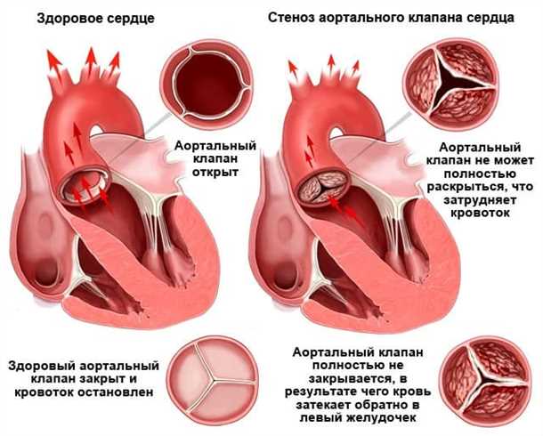 Влияние сопутствующих патологий на клинический образ пролапса митрального клапана