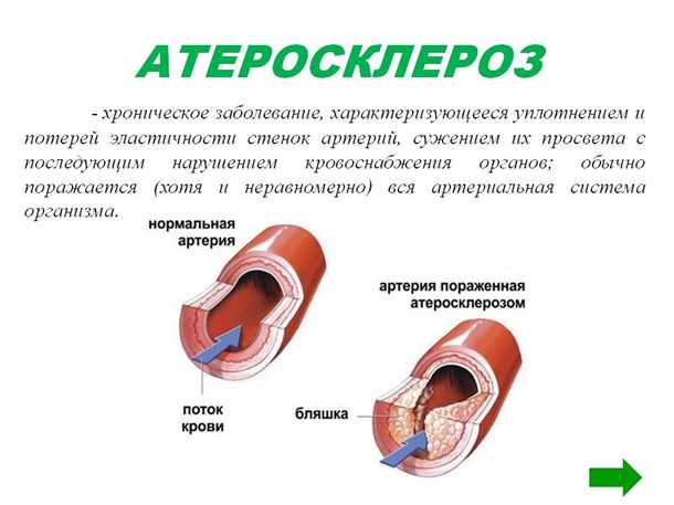 Воздействие артериосклероза на состояние кровообращения в организме