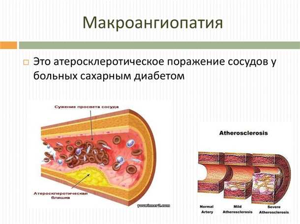 Сосудистые изменения при сахарном диабете: механизмы и профилактика.