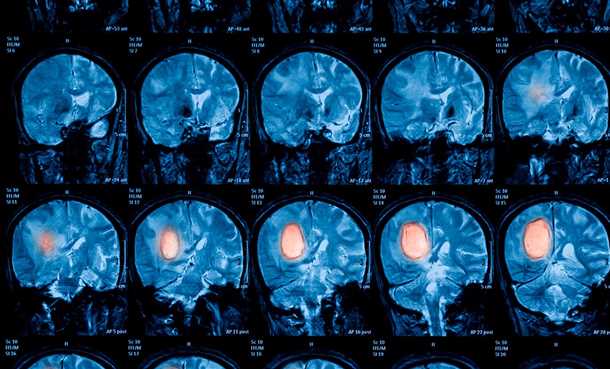 Аневризмы и сосудистые мальформации