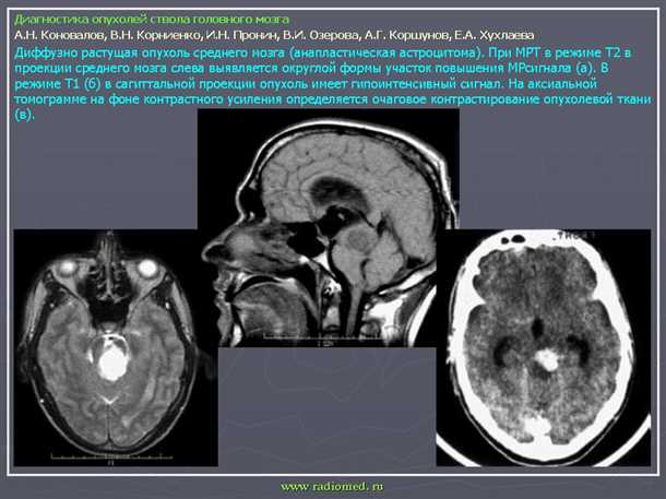 Сосудистые кисты и опухоли головного мозга - эффективные методы исследования и лечения в современной медицине Сосудистые кисты и опухоли головного мозга: методы диагностики и терапии.