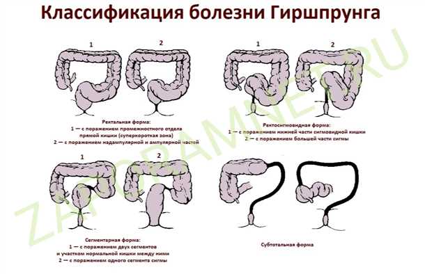 Прчины стеноза кишечника