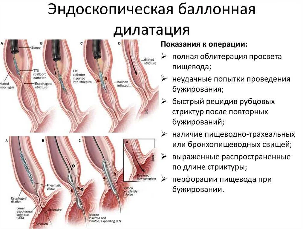 Воспаление кишечника