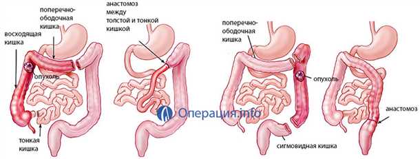 2. Запоры и нарушение стула