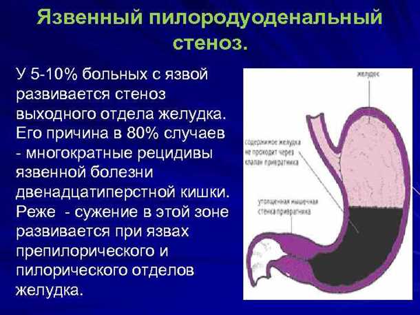 4. Отрыжка и изжога