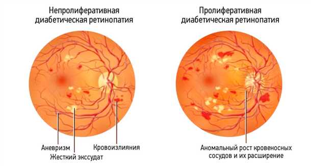 Стоимость лечения диабетической ретинопатии