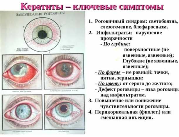 Субконъюнктивальное кровоизлияние: симптомы, причины, осложнения