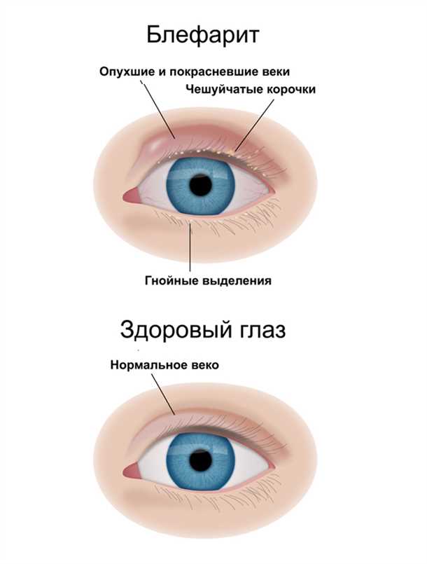 1. Покой и ограничение физической активности