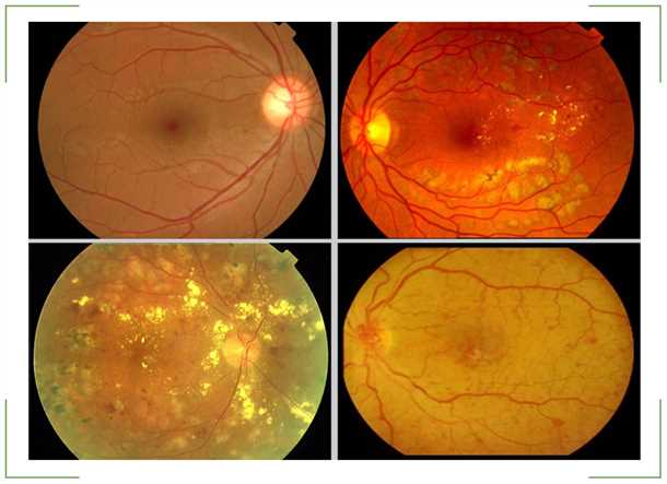 Симптомы и прогрессирование компенсированной формы ВМД