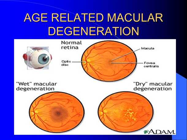 Что характерно для компенсированной формы ВМД?