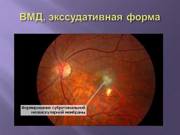 Сухая форма ВМД — не самый худший вариант заболевания сетчатки глаза