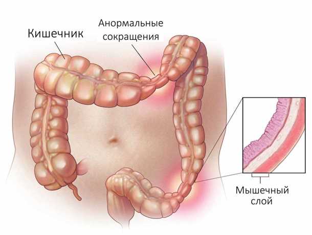Диагностика тенезмы кишечника