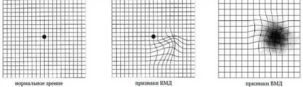 Тест Амслера и возможности домашней проверки