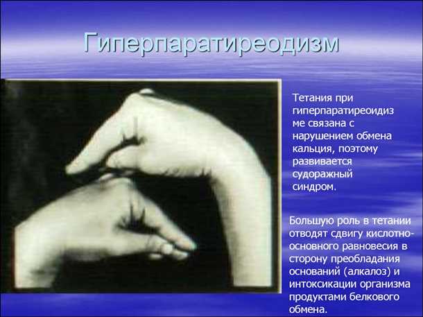 Диагностика тетании
