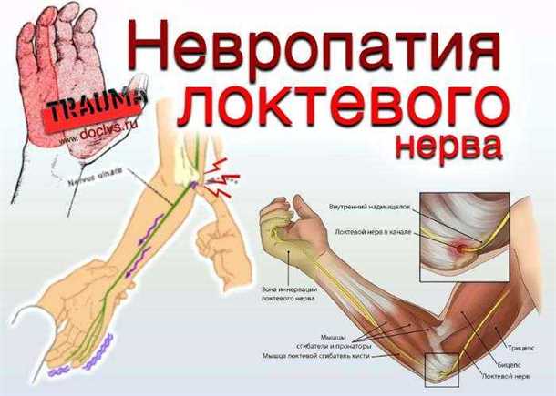 Понятие травматических невропатий