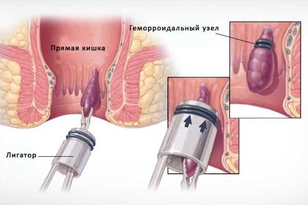 Основные рекомендации для профилактики тромбоза геморроидального узла: