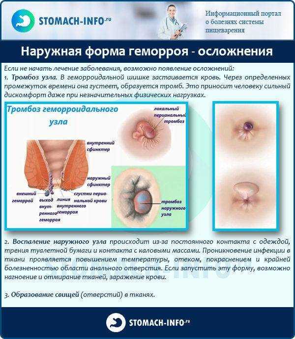 Тромбоз геморроидального узла: симптомы и лечение (медикаменты, хирургия)