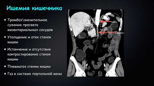 3. Сердечная недостаточность
