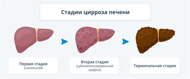 Прогноз жизни при циррозе печени и употреблении алкоголя