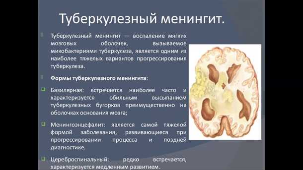Инфекционные причины менингита
