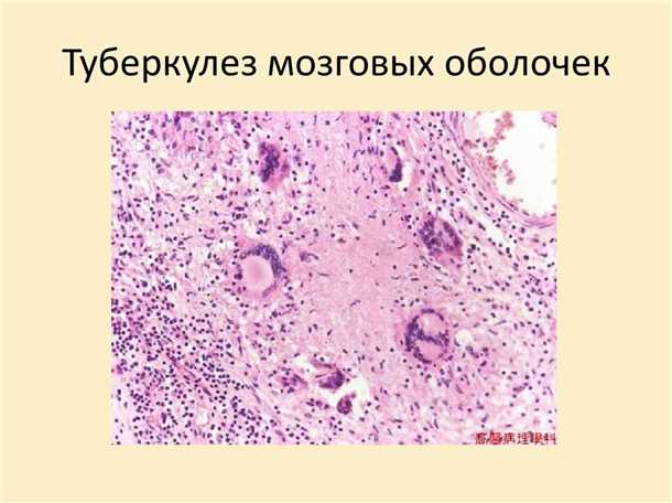Туберкулезный менингит.