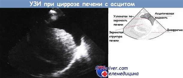 Симптомы и причины развития цирроза печени
