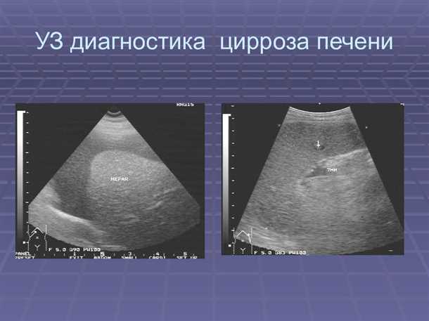 2. Портальная гипертензия
