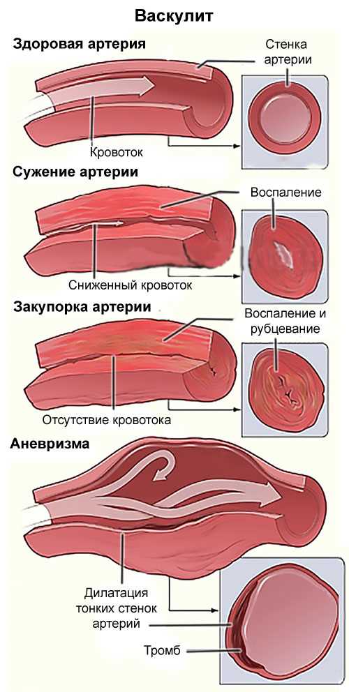 Васкулиты центральной нервной системы.