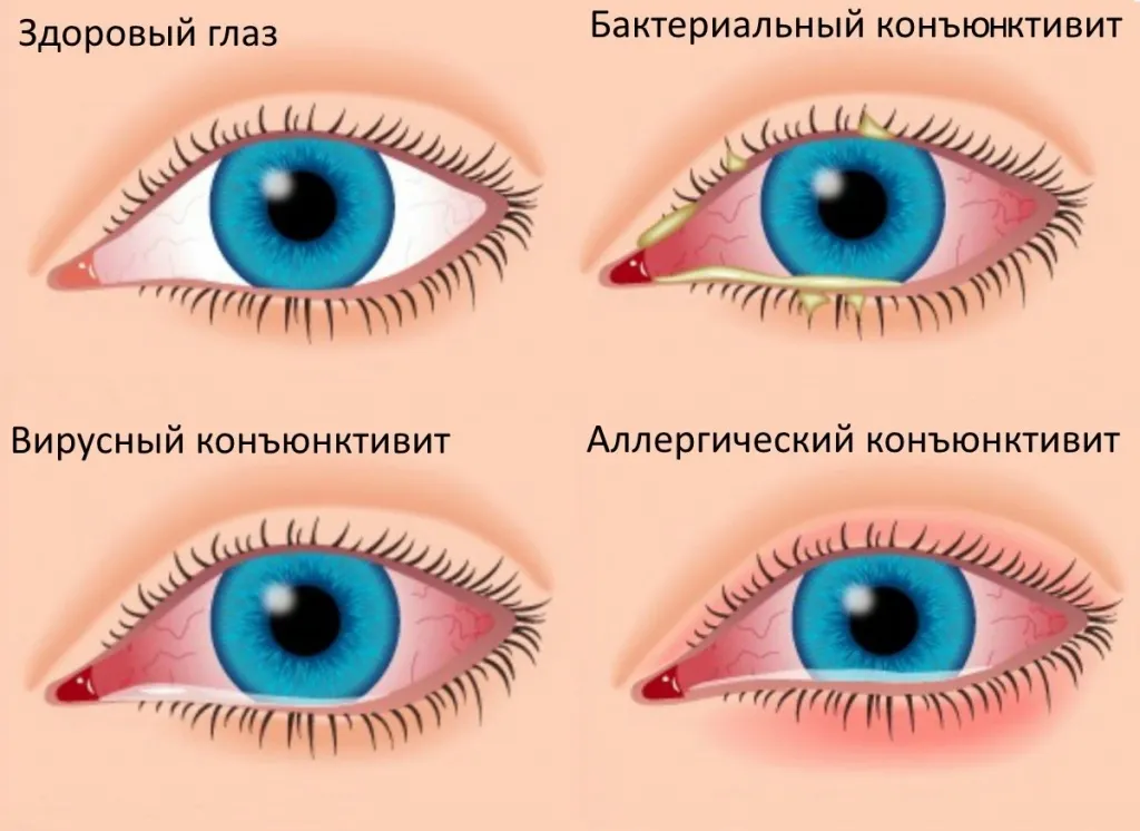 Эстетическое корректирование век глаза: инъекционные методики