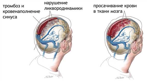 Венозные тромбозы головного мозга: диагностика и хирургическое лечение.