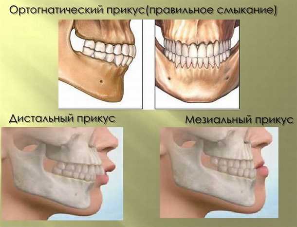 Перекрестный прикус и его виды