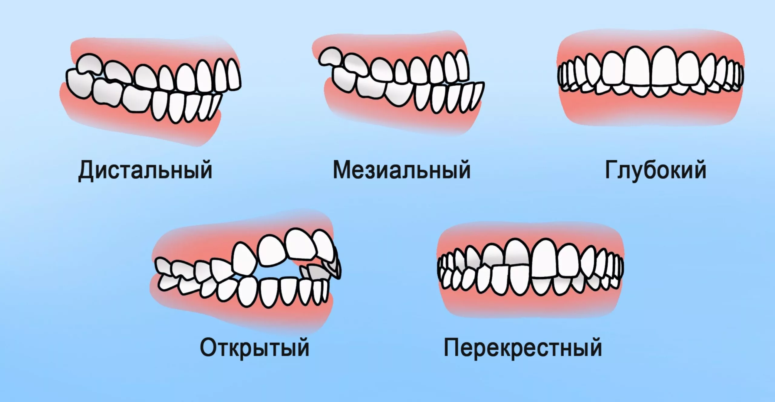1. Классификация по типу челюсти