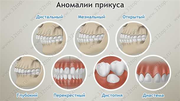 Виды перекрестного прикуса: