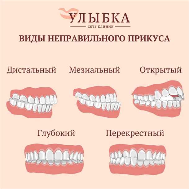 Прикус с отклонением срединной линии
