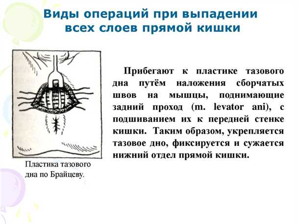 Консервативное лечение выпадения прямой кишки