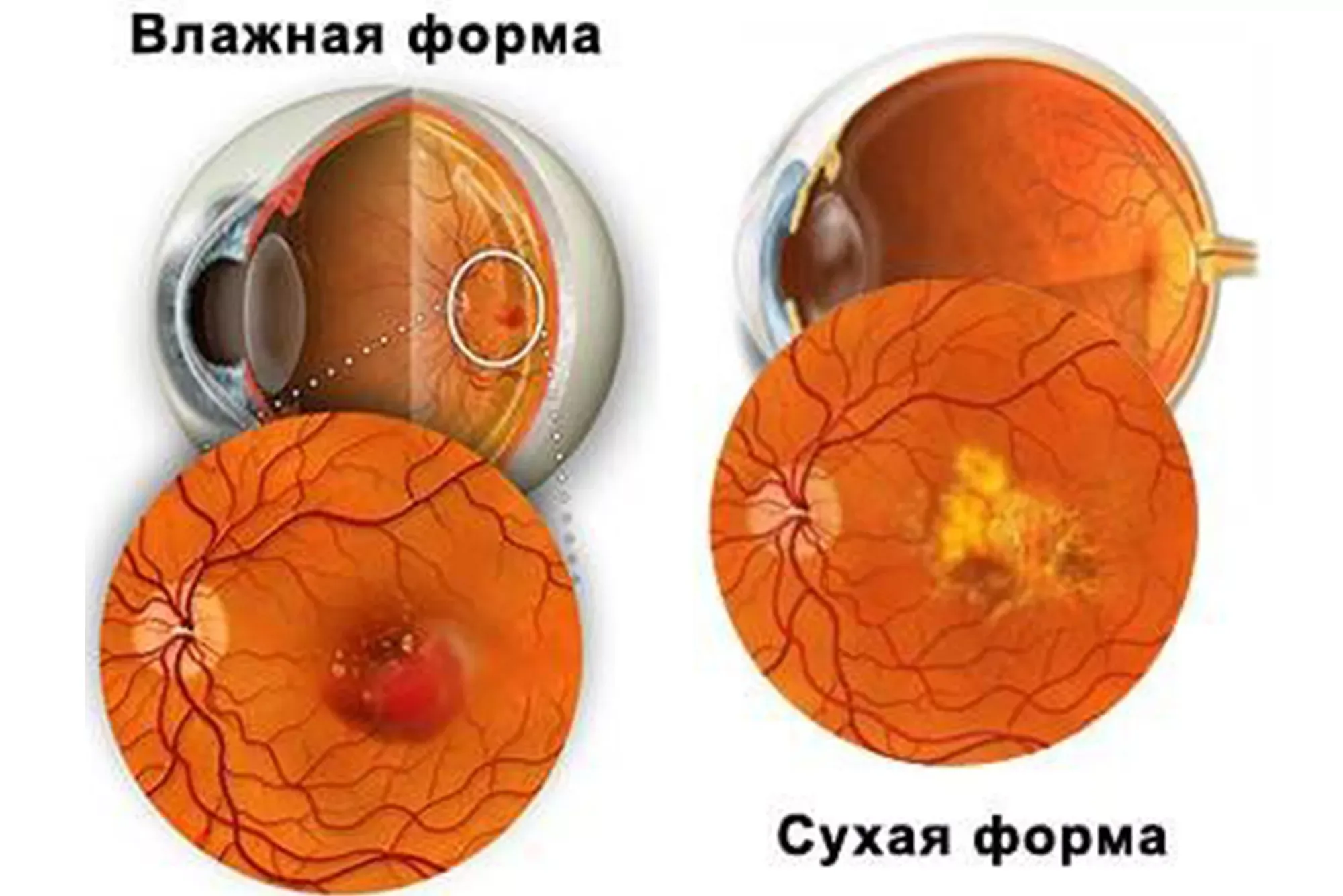 Прогрессия заболевания