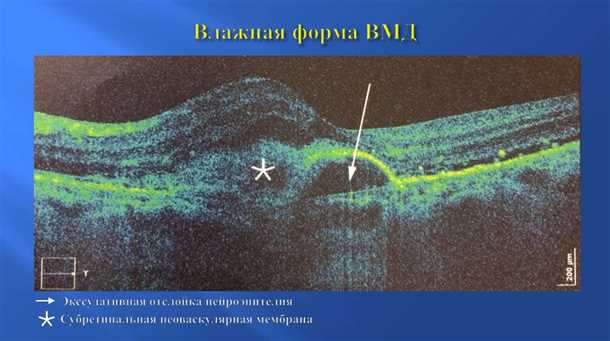 Диагностика и лечение влажной формы ВМД