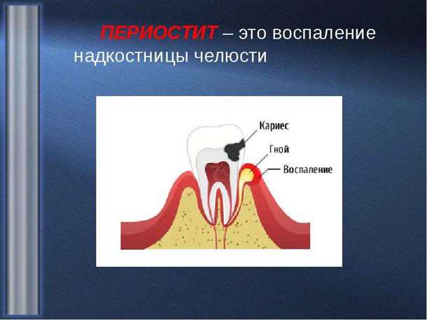 Воспаление надкостницы зуба