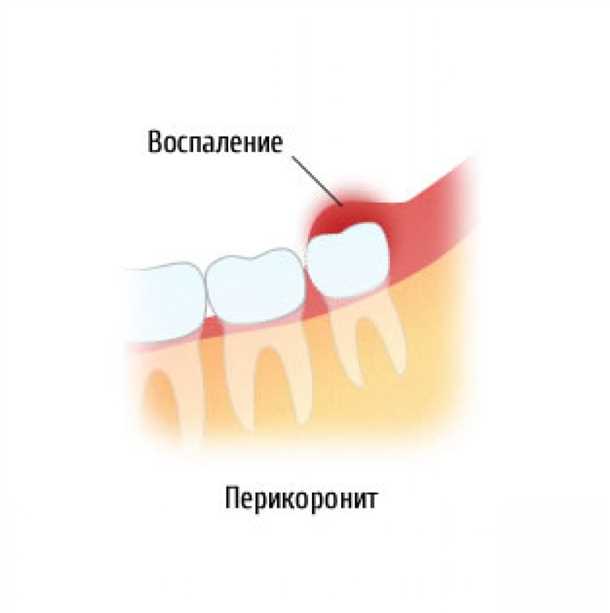 Профилактика воспаления десны около зуба мудрости