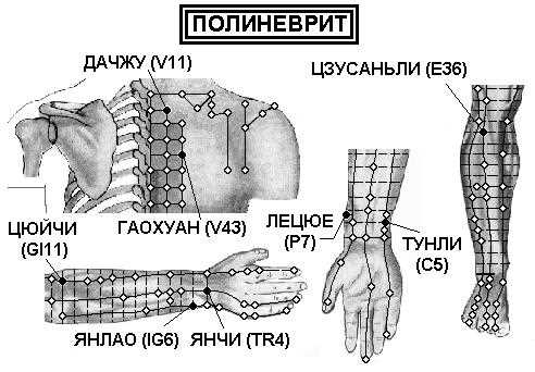 Воспалительный полиневрит.