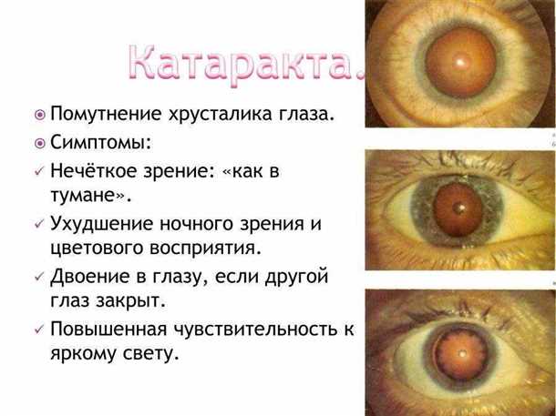 Симптомы и проявления врожденной катаракты
