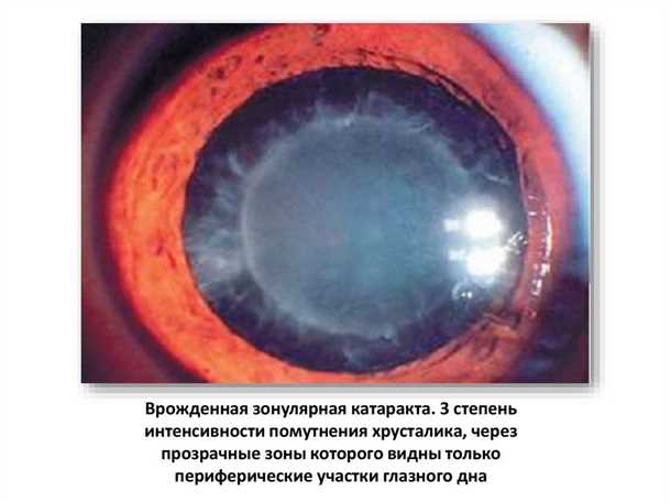 Основные признаки врожденной катаракты