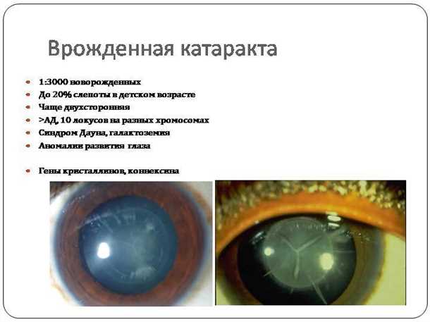Врожденная катаракта - признаки, симптомы, лечение