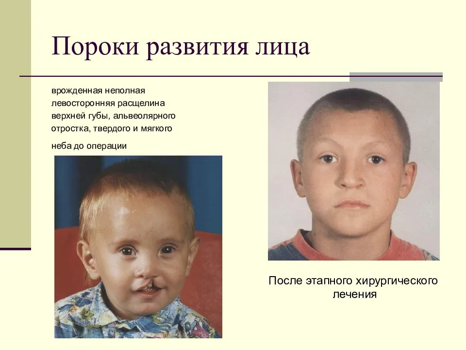Врожденные аномалии сосудов и их влияние на развитие неврологических патологий у детей.
