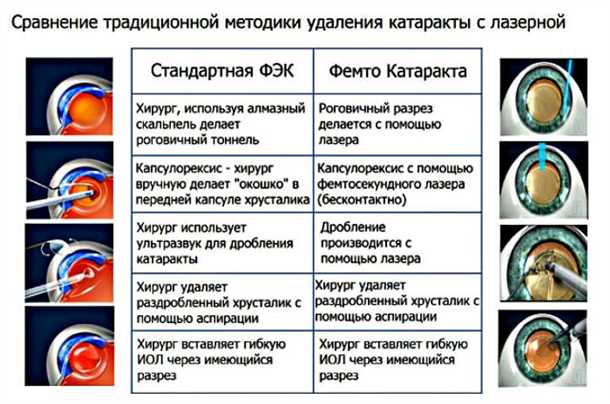 Процедура лечения вторичной катаракты лазером