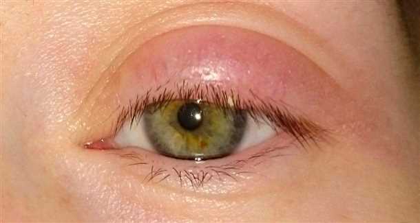 Халязион причины, симптомы, лечение. Все про глазные болезни