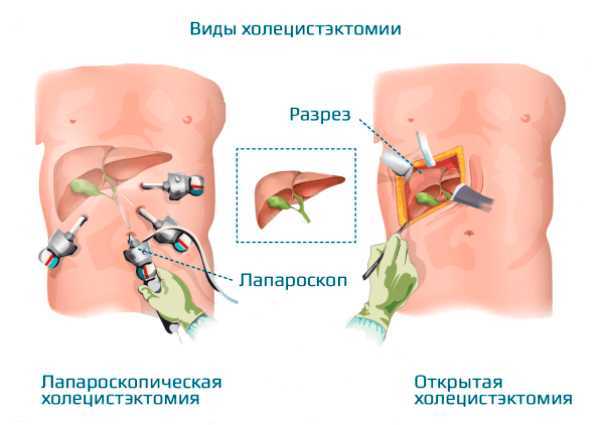 Жизнь после холецистэктомии