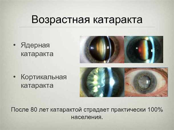 Ядерная катаракта: профилактика и рекомендации