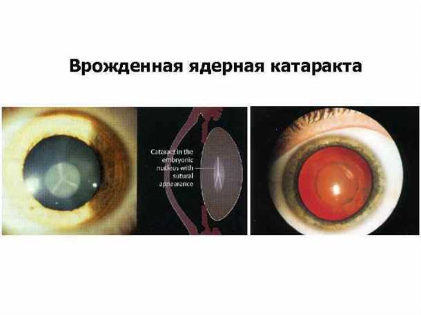 Что означает понятие ядерной катаракты и как ее предотвратить? Ядерная катаракта – что это такое?