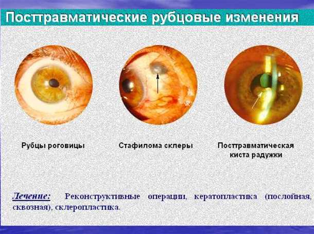 Лечение язвы роговицы